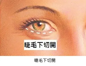 睫毛下眼袋切除術