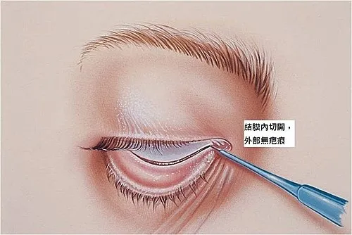結膜內眼袋切除術