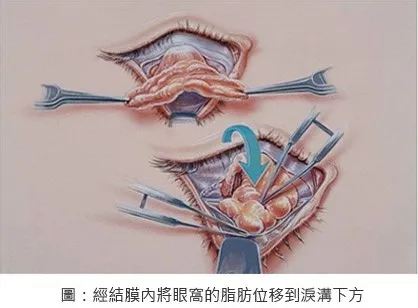 眼袋內開脂肪位移手術
