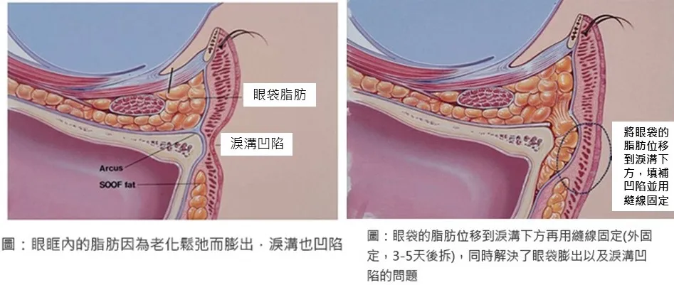 眼袋手術改善淚溝術後示意圖