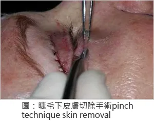 結膜內眼袋脂肪位移手術