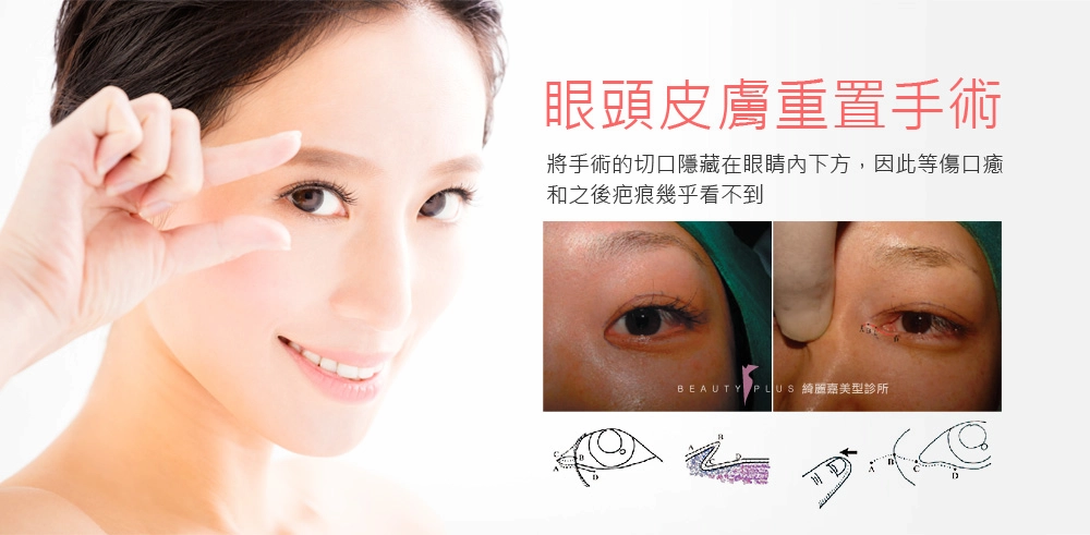 眼頭皮膚重置手術