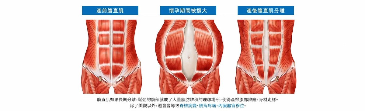 EMSCULPT® 肌動減脂 EMSCULPT® 肌動減脂