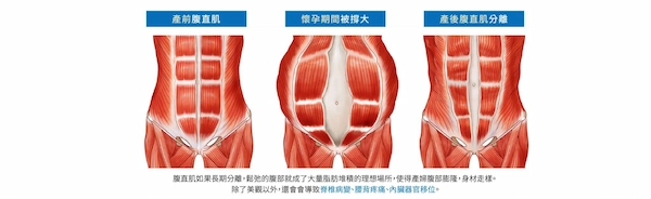 EMSCULPT® 肌動減脂 EMSCULPT® 肌動減脂