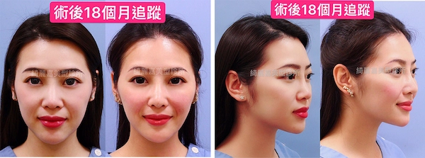 玻尿酸 推薦開眼頭,眼尾,眼袋手術,微笑唇,改善淚溝,提眼肌無力|綺麗嘉