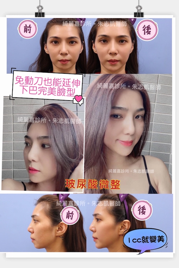 玻尿酸 推薦縮人中,縮鼻頭,鼻翼,眼尾下置手術推薦