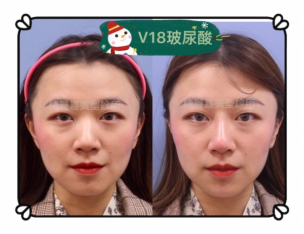 玻尿酸 推薦縮人中,縮鼻頭,鼻翼,眼尾下置手術推薦