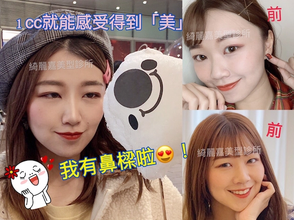 玻尿酸
