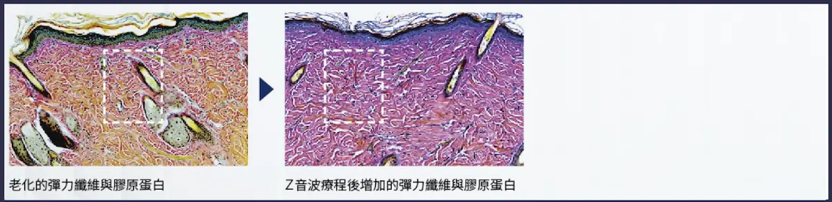 彈力纖維與膠原蛋白變化