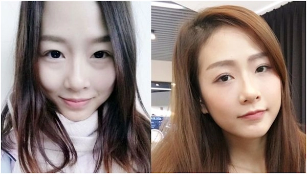 消除眼袋報導