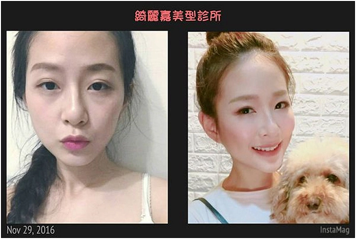 消除眼袋報導