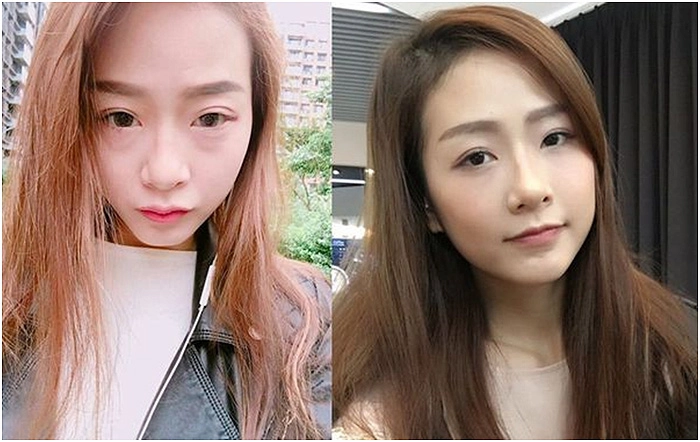 消除眼袋報導