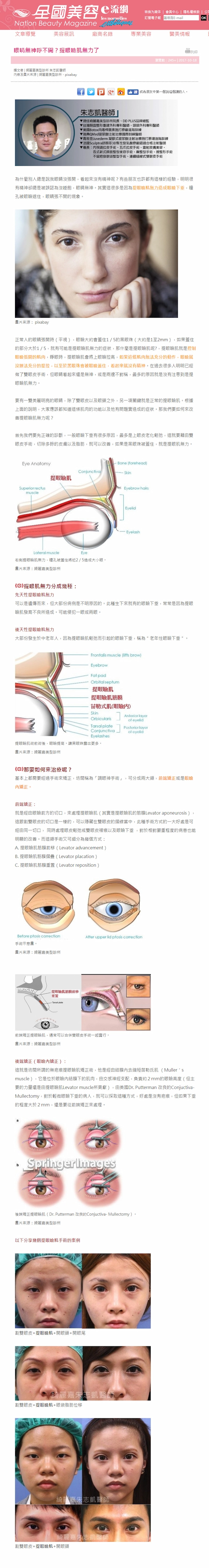 提眼瞼肌報導