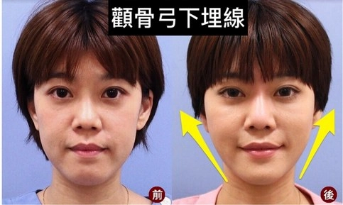 神力拉提埋線 神力拉提埋線