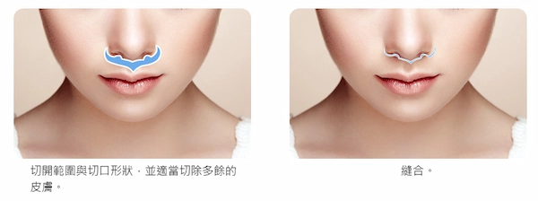 手術的方式 縮人中手術的方式
