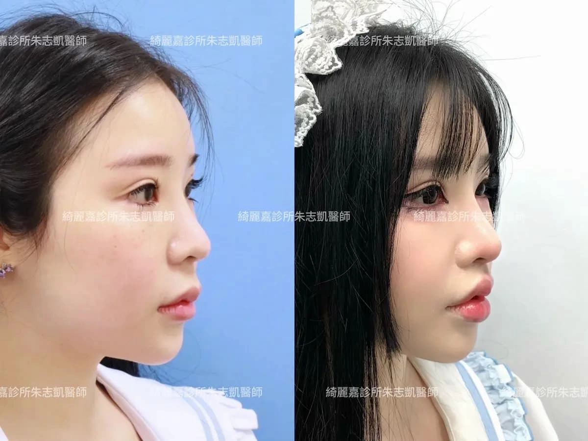 案例D 縮人中案例D