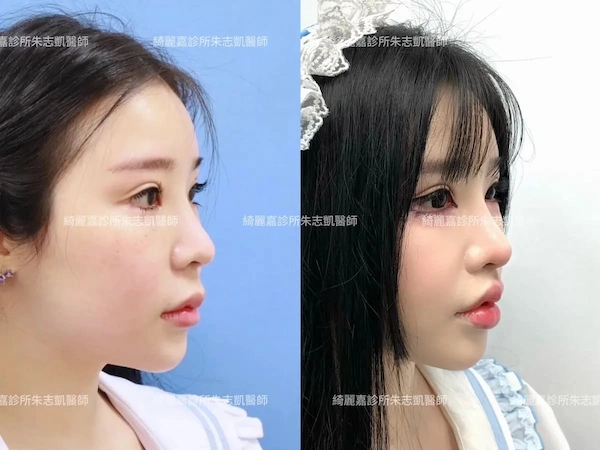 案例C 縮人中案例C