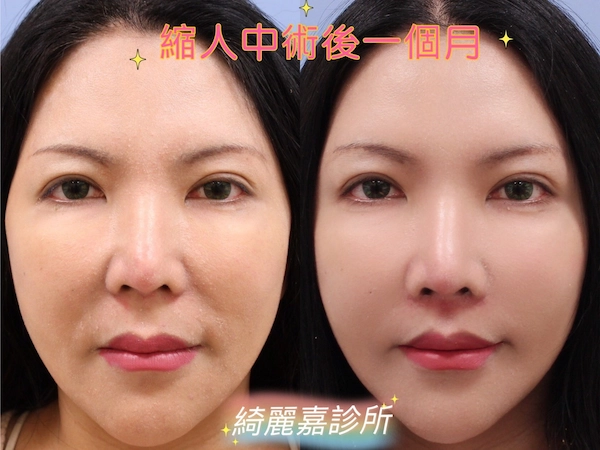 案例 縮人中案例
