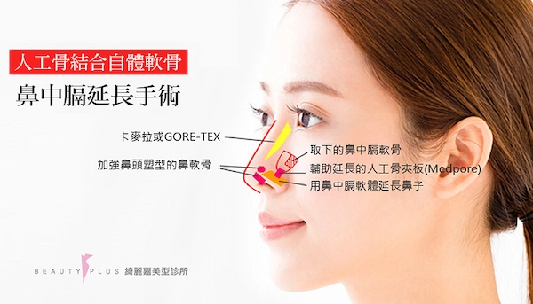 鼻中膈延長手術