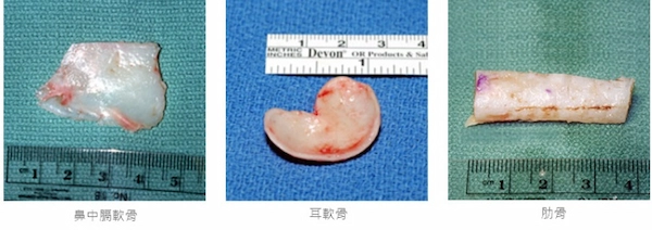 結構性隆鼻 結構性隆鼻