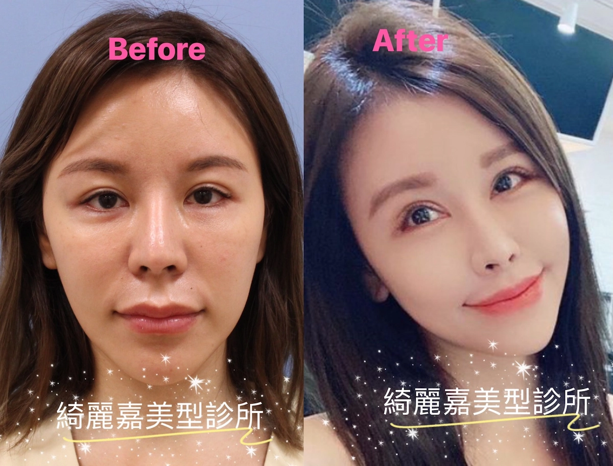 法令紋墊片蛻變分享