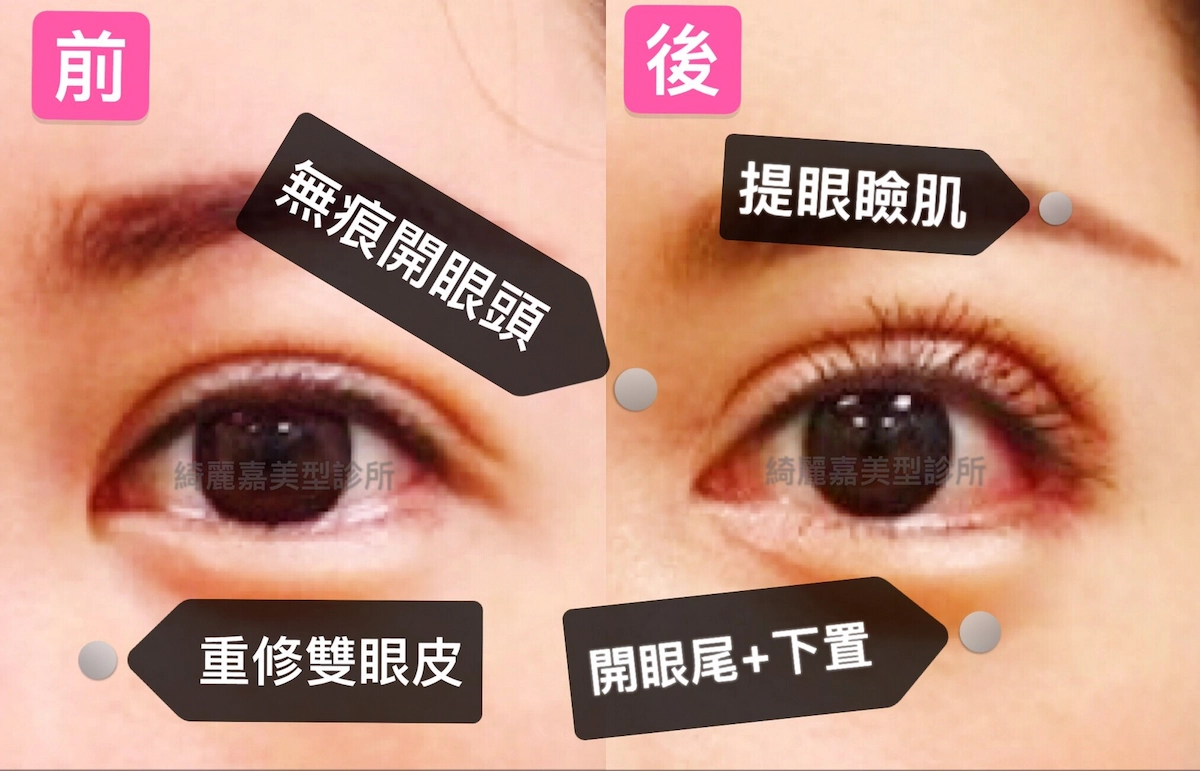 開眼尾及下置