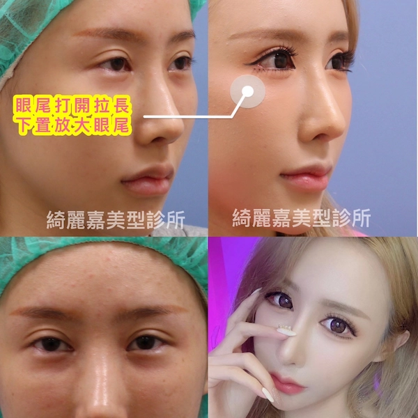 開眼尾及下置