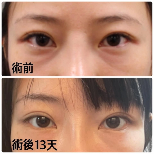 開眼尾及下置