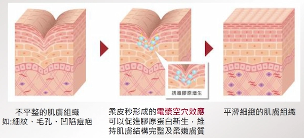 PicoLO柔皮秒 PicoLO柔皮秒