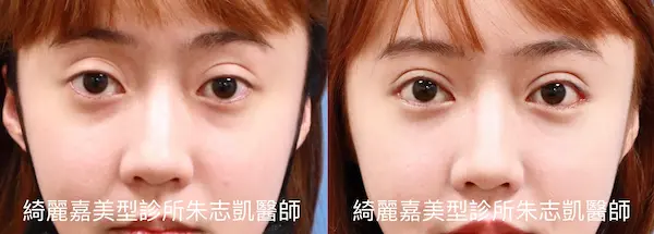 眼肌無力案例4-2