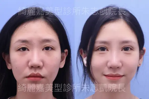 眼肌無力案例5-4