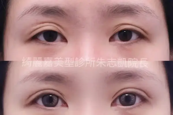 眼肌無力案例5-2