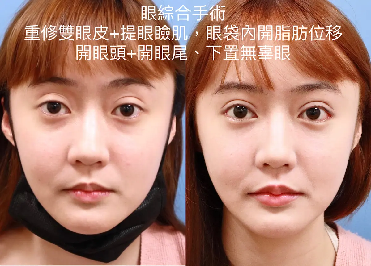 重修雙眼皮手術案例四-2