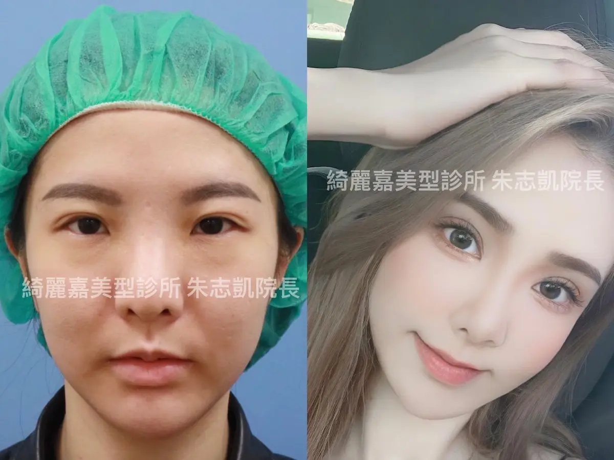 眼肌無力案例3