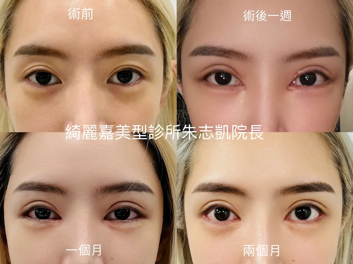 開眼尾及下置