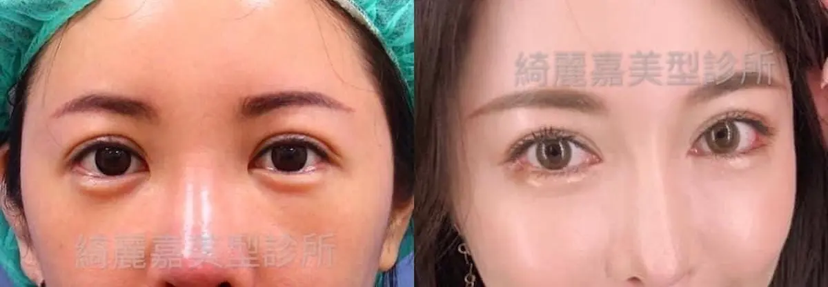 重修雙眼皮手術案例二