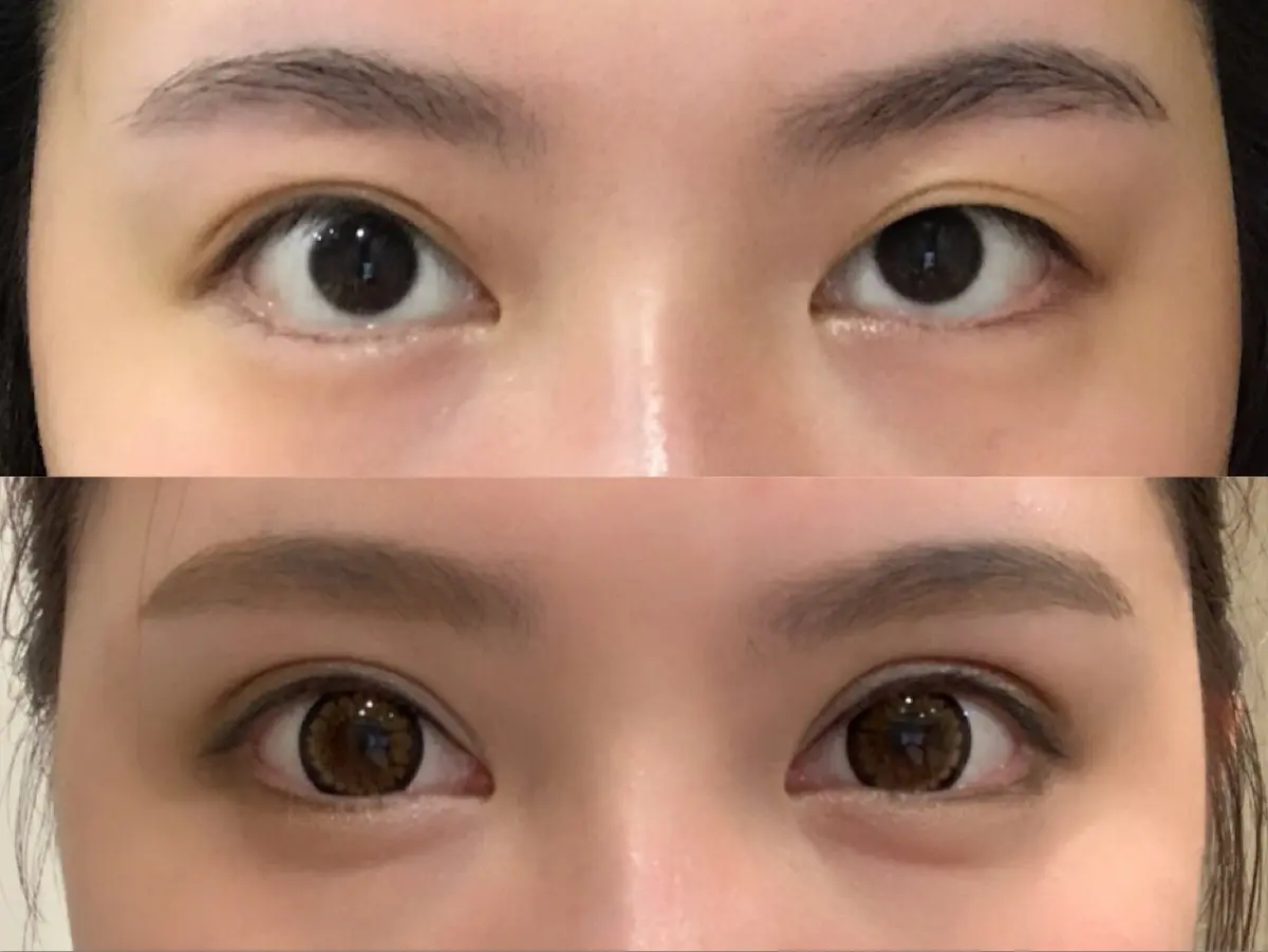 眼肌無力案例10