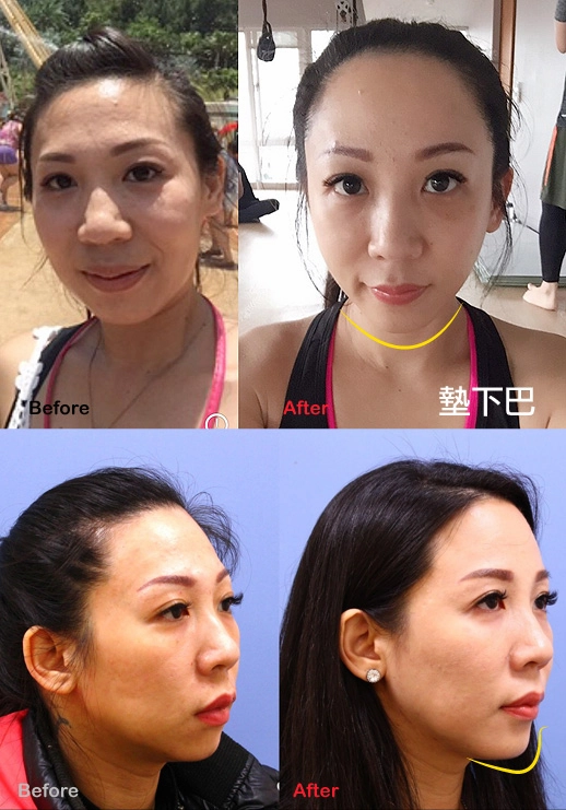 內開下巴手術 內開下巴手術