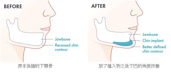 內開下巴手術 內開下巴手術