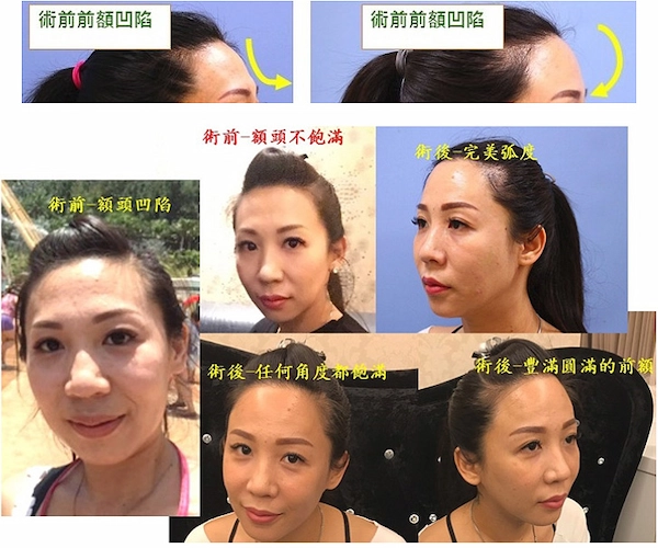 豐額手術 豐額手術