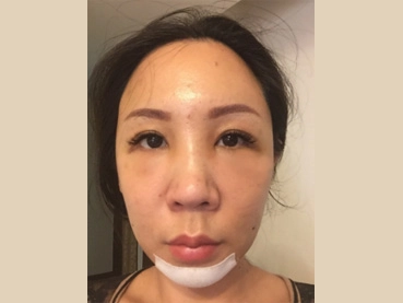 豐額手術 豐額手術