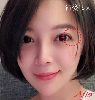 重修割雙眼皮術後15天