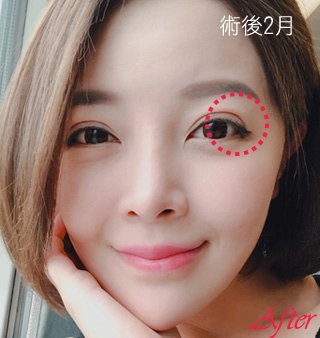 重修雙眼皮術後兩個月