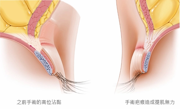 重修雙眼皮高位沾黏