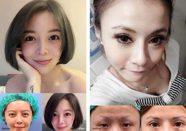割雙眼皮案例