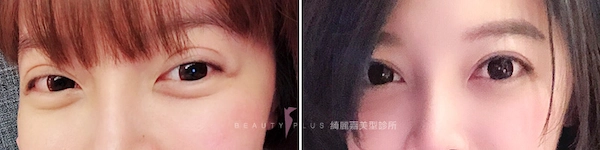 重修雙眼皮和眼瞼肌無力症狀