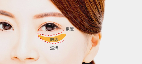 眼袋、淚溝、黑眼圈和臥蠶分辨