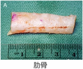 軟骨鼻整形 軟骨鼻整形