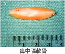自體軟骨鼻整形 自體軟骨鼻整形