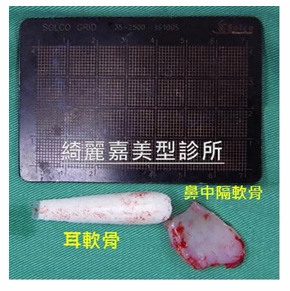結構性隆鼻 結構性隆鼻